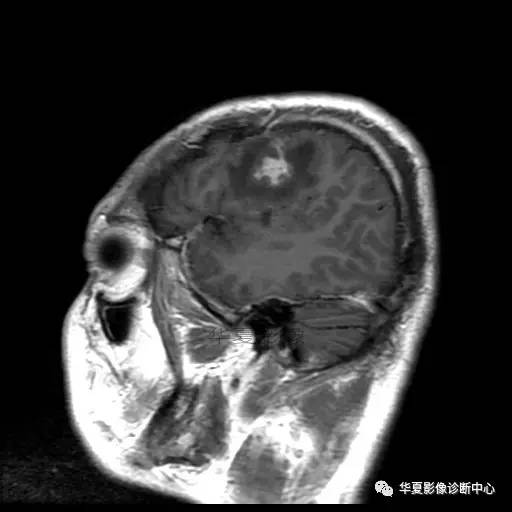 血吸虫脑病的影像诊断 血吸虫脑病的影像诊断
