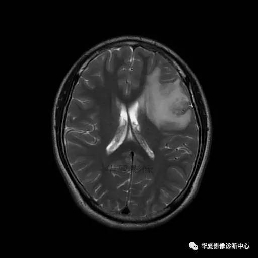 血吸虫脑病的影像诊断 血吸虫脑病的影像诊断