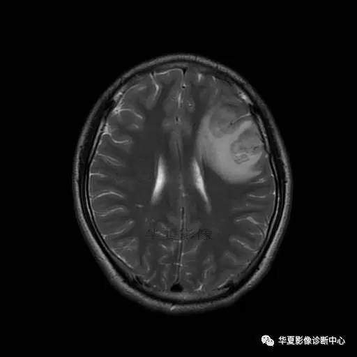 血吸虫脑病的影像诊断 血吸虫脑病的影像诊断