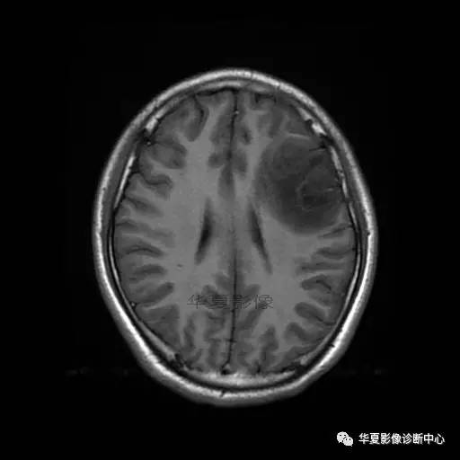 血吸虫脑病的影像诊断 血吸虫脑病的影像诊断