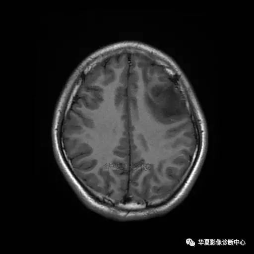 血吸虫脑病的影像诊断 血吸虫脑病的影像诊断