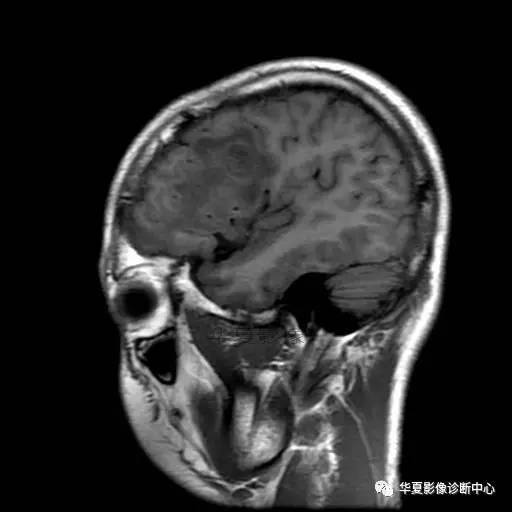 血吸虫脑病的影像诊断 血吸虫脑病的影像诊断