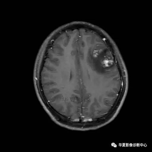 血吸虫脑病的影像诊断 血吸虫脑病的影像诊断