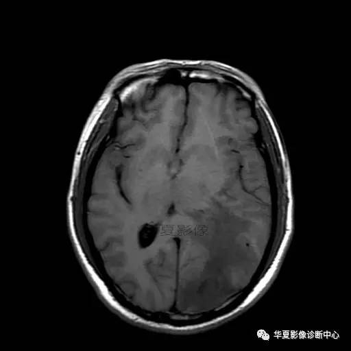 血吸虫脑病的影像诊断 血吸虫脑病的影像诊断
