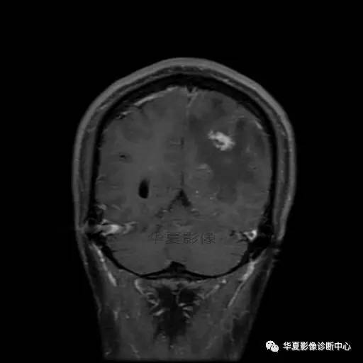 血吸虫脑病的影像诊断 血吸虫脑病的影像诊断