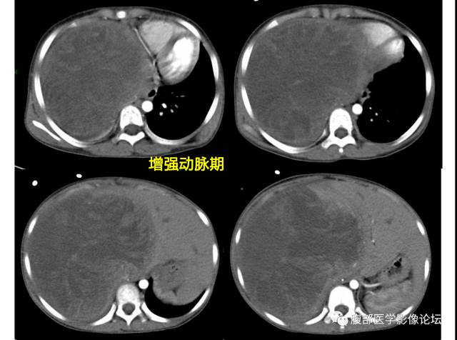 【病例】肝未分化胚胎型肉瘤1例CT 【病例】肝未分化胚胎型肉瘤1例CT