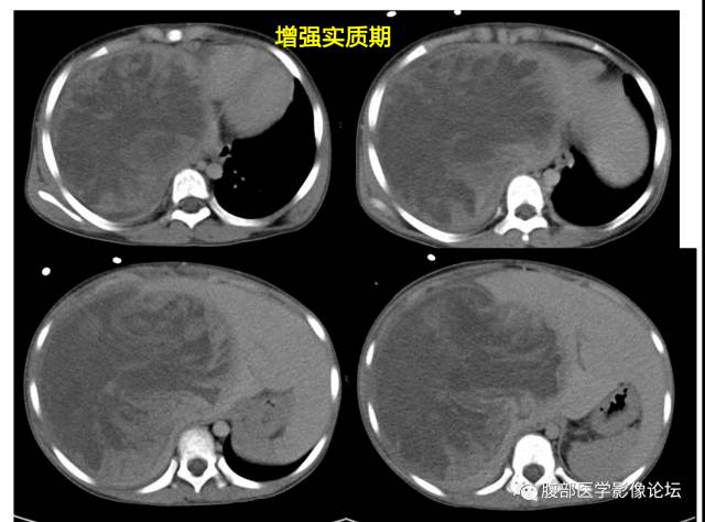 【病例】肝未分化胚胎型肉瘤1例CT 【病例】肝未分化胚胎型肉瘤1例CT