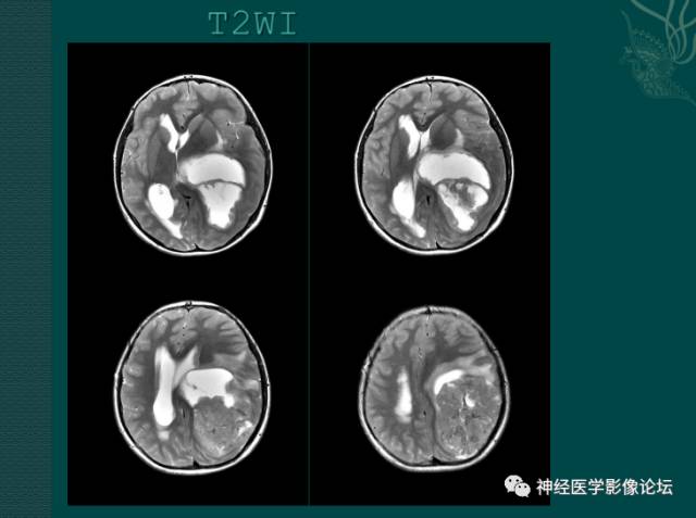 【病例】中枢神经母细胞瘤一例CT及MR 【病例】中枢神经母细胞瘤一例CT及MR