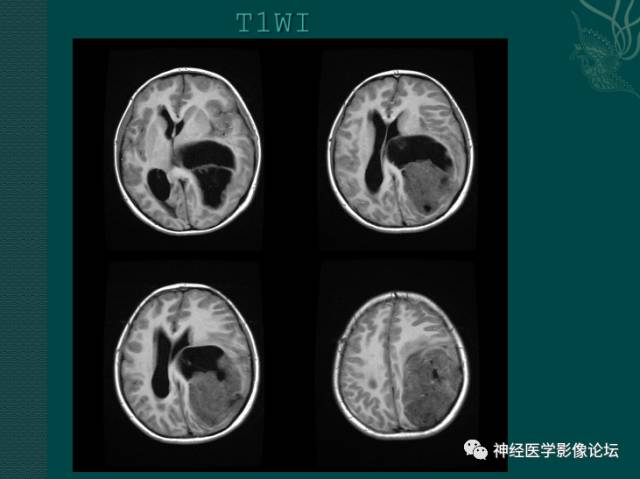 【病例】中枢神经母细胞瘤一例CT及MR 【病例】中枢神经母细胞瘤一例CT及MR