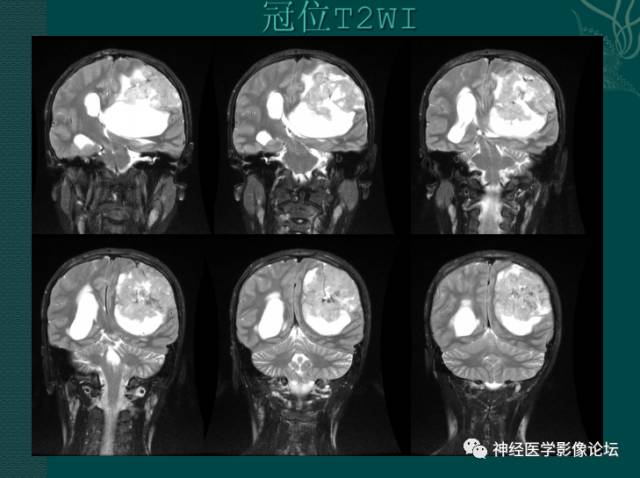 【病例】中枢神经母细胞瘤一例CT及MR 【病例】中枢神经母细胞瘤一例CT及MR