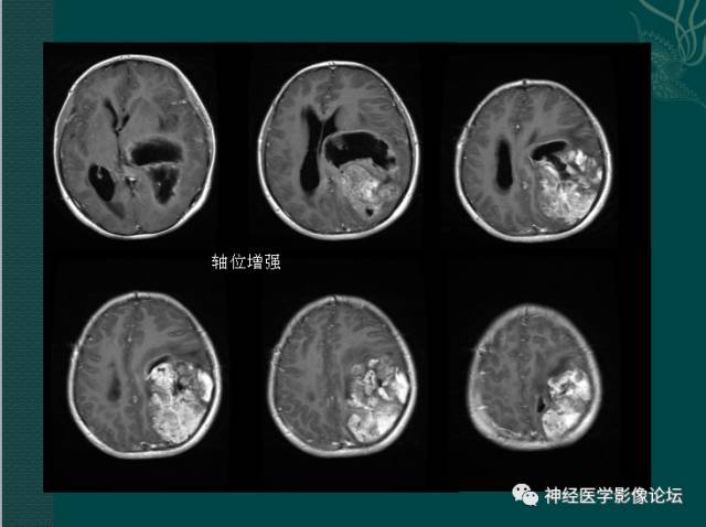 【病例】中枢神经母细胞瘤一例CT及MR 【病例】中枢神经母细胞瘤一例CT及MR