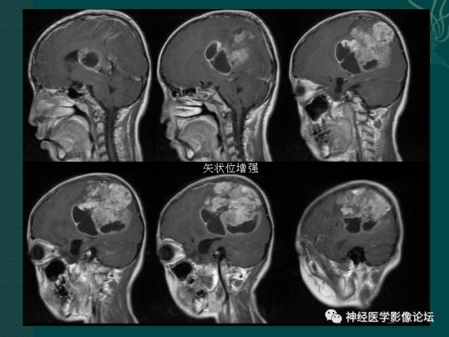 【病例】中枢神经母细胞瘤一例CT及MR 【病例】中枢神经母细胞瘤一例CT及MR