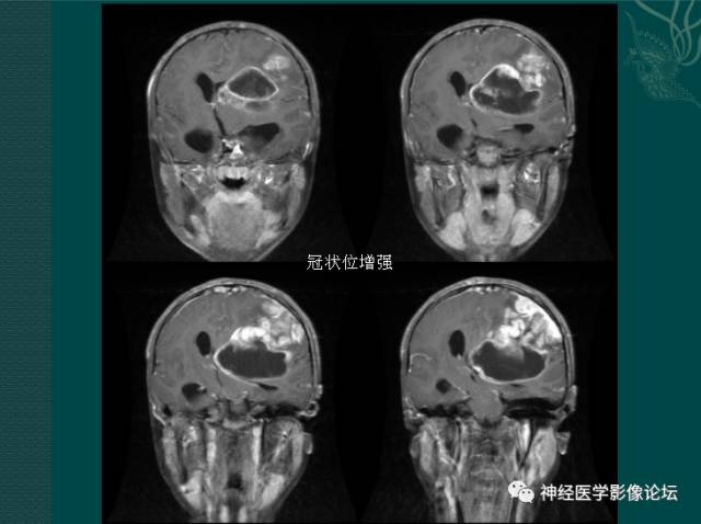【病例】中枢神经母细胞瘤一例CT及MR 【病例】中枢神经母细胞瘤一例CT及MR