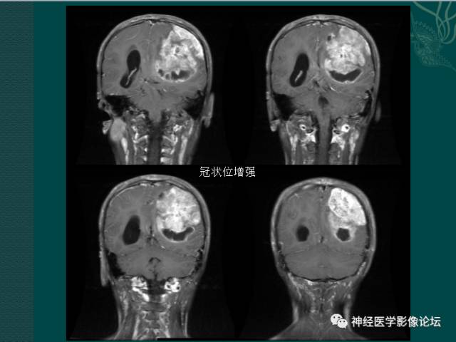 【病例】中枢神经母细胞瘤一例CT及MR 【病例】中枢神经母细胞瘤一例CT及MR