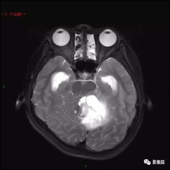 【典型病例】小脑毛细胞型星形细胞瘤1例MR影像讨论 【典型病例】小脑毛细胞型星形细胞瘤1例MR影像讨论
