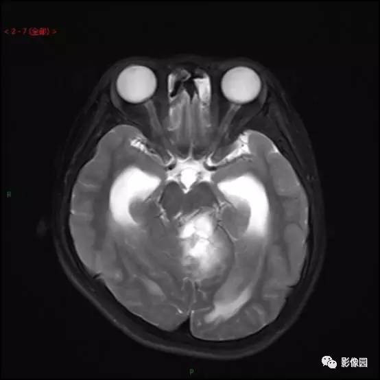 【典型病例】小脑毛细胞型星形细胞瘤1例MR影像讨论 【典型病例】小脑毛细胞型星形细胞瘤1例MR影像讨论