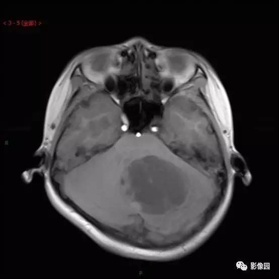 【典型病例】小脑毛细胞型星形细胞瘤1例MR影像讨论 【典型病例】小脑毛细胞型星形细胞瘤1例MR影像讨论