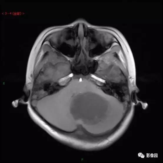【典型病例】小脑毛细胞型星形细胞瘤1例MR影像讨论 【典型病例】小脑毛细胞型星形细胞瘤1例MR影像讨论