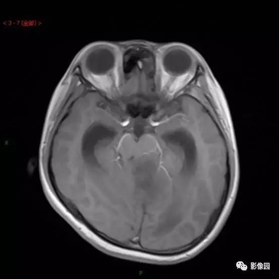 【典型病例】小脑毛细胞型星形细胞瘤1例MR影像讨论 【典型病例】小脑毛细胞型星形细胞瘤1例MR影像讨论