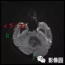 【典型病例】小脑毛细胞型星形细胞瘤1例MR影像讨论 【典型病例】小脑毛细胞型星形细胞瘤1例MR影像讨论