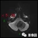 【典型病例】小脑毛细胞型星形细胞瘤1例MR影像讨论 【典型病例】小脑毛细胞型星形细胞瘤1例MR影像讨论