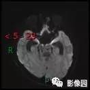 【典型病例】小脑毛细胞型星形细胞瘤1例MR影像讨论 【典型病例】小脑毛细胞型星形细胞瘤1例MR影像讨论