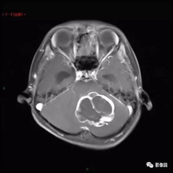 【典型病例】小脑毛细胞型星形细胞瘤1例MR影像讨论 【典型病例】小脑毛细胞型星形细胞瘤1例MR影像讨论