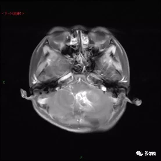 【典型病例】小脑毛细胞型星形细胞瘤1例MR影像讨论 【典型病例】小脑毛细胞型星形细胞瘤1例MR影像讨论