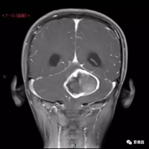 【典型病例】小脑毛细胞型星形细胞瘤1例MR影像讨论 【典型病例】小脑毛细胞型星形细胞瘤1例MR影像讨论