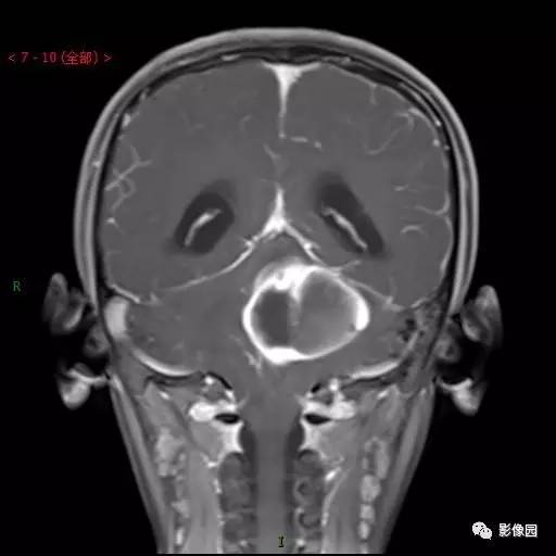 【典型病例】小脑毛细胞型星形细胞瘤1例MR影像讨论 【典型病例】小脑毛细胞型星形细胞瘤1例MR影像讨论