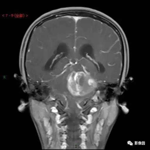【典型病例】小脑毛细胞型星形细胞瘤1例MR影像讨论 【典型病例】小脑毛细胞型星形细胞瘤1例MR影像讨论