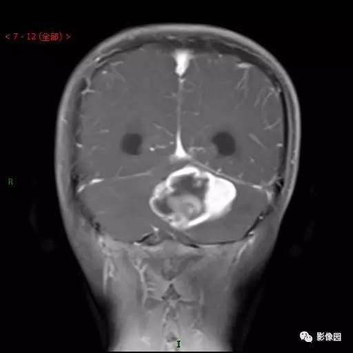 【典型病例】小脑毛细胞型星形细胞瘤1例MR影像讨论 【典型病例】小脑毛细胞型星形细胞瘤1例MR影像讨论