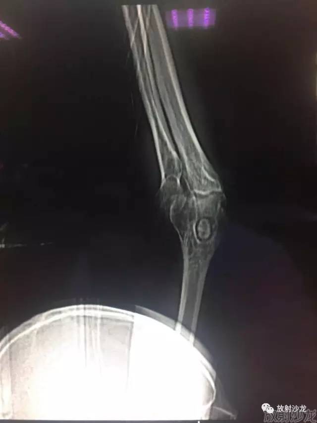 【病例】常被误诊的肱骨滑车上孔小骨1例 【病例】常被误诊的肱骨滑车上孔小骨1例
