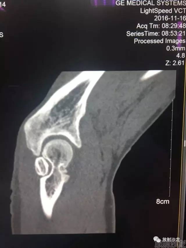 【病例】常被误诊的肱骨滑车上孔小骨1例