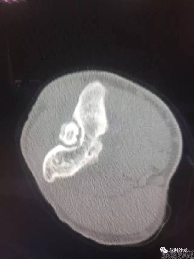 【病例】常被误诊的肱骨滑车上孔小骨1例 【病例】常被误诊的肱骨滑车上孔小骨1例