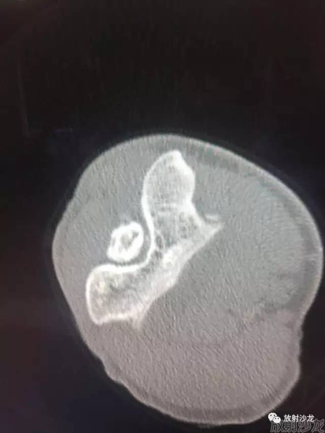 【病例】常被误诊的肱骨滑车上孔小骨1例 【病例】常被误诊的肱骨滑车上孔小骨1例