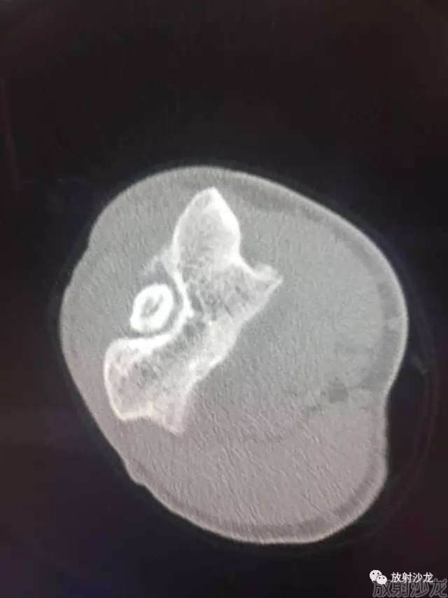 【病例】常被误诊的肱骨滑车上孔小骨1例 【病例】常被误诊的肱骨滑车上孔小骨1例