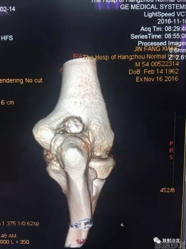 【病例】常被误诊的肱骨滑车上孔小骨1例 【病例】常被误诊的肱骨滑车上孔小骨1例
