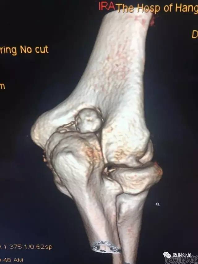 【病例】常被误诊的肱骨滑车上孔小骨1例 【病例】常被误诊的肱骨滑车上孔小骨1例