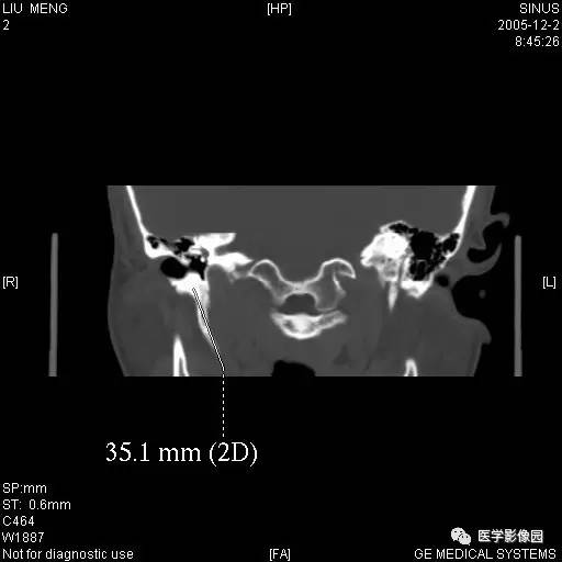 茎突综合征