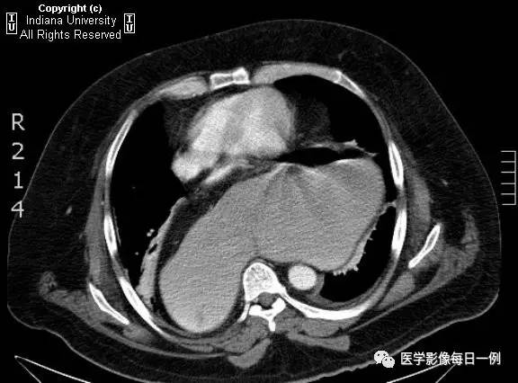 【病例】胃扭转并穿孔1例X线CT