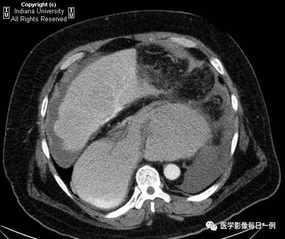 【病例】胃扭转并穿孔1例X线CT 【病例】胃扭转并穿孔1例X线CT