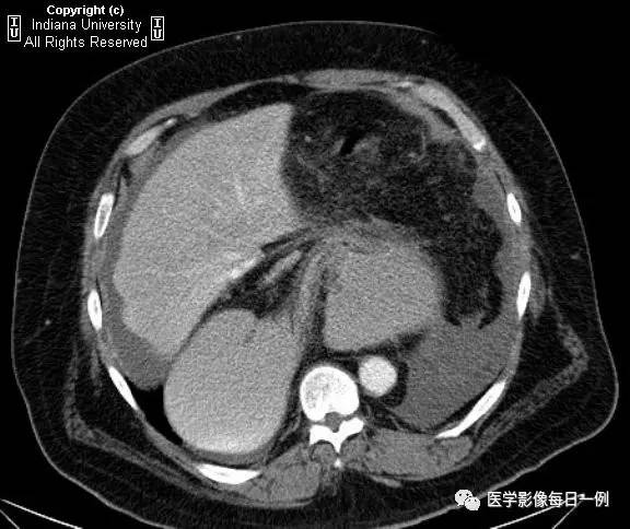 【病例】胃扭转并穿孔1例X线CT 【病例】胃扭转并穿孔1例X线CT