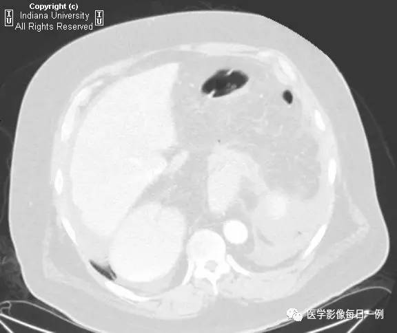 【病例】胃扭转并穿孔1例X线CT 【病例】胃扭转并穿孔1例X线CT