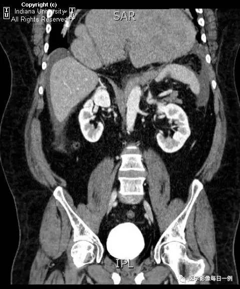 【病例】胃扭转并穿孔1例X线CT 【病例】胃扭转并穿孔1例X线CT