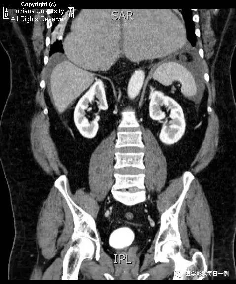 【病例】胃扭转并穿孔1例X线CT 【病例】胃扭转并穿孔1例X线CT