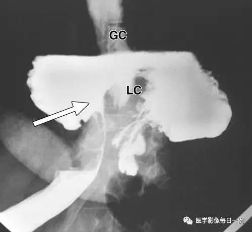 【病例】胃扭转并穿孔1例X线CT 【病例】胃扭转并穿孔1例X线CT