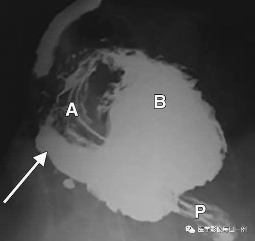 【病例】胃扭转并穿孔1例X线CT 【病例】胃扭转并穿孔1例X线CT