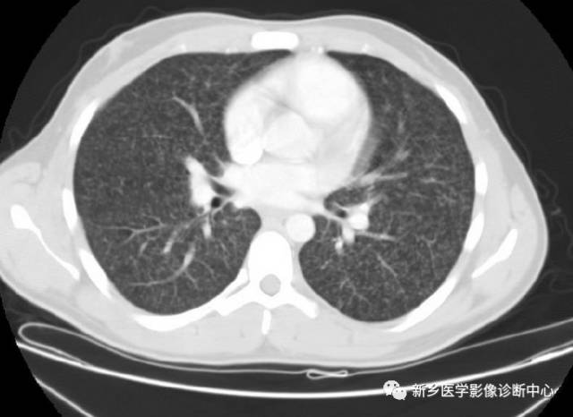 看到肺内多发结节一定要想到的9种病变