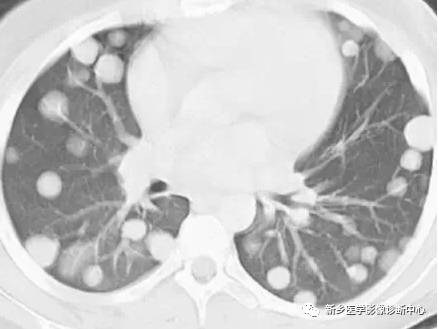 看到肺内多发结节一定要想到的9种病变